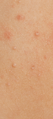 Ejemplo de Molusco Contagioso