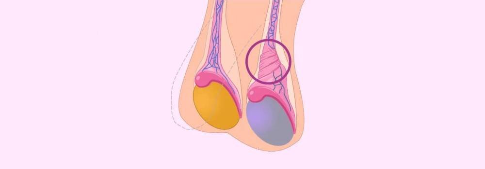 Ejemplo de Torsión Testicular