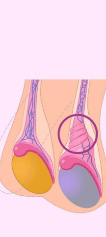 Ejemplo Torsión Testicular